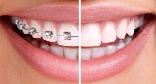 Invisalign Benefits, Surrey Dentist